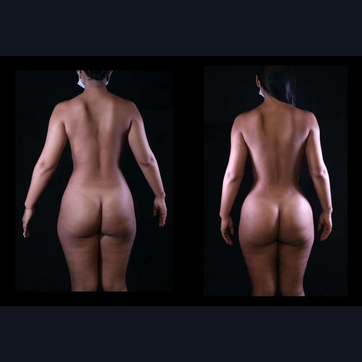 BBL in Colombia: back view before and after with Dr. Daniel Ramos, Bogotá