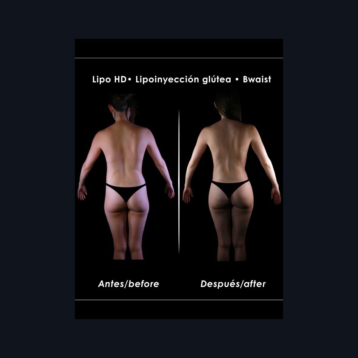 BBL with Lipo 360 in Colombia: gluteal fat transfer and defined waist, before and after