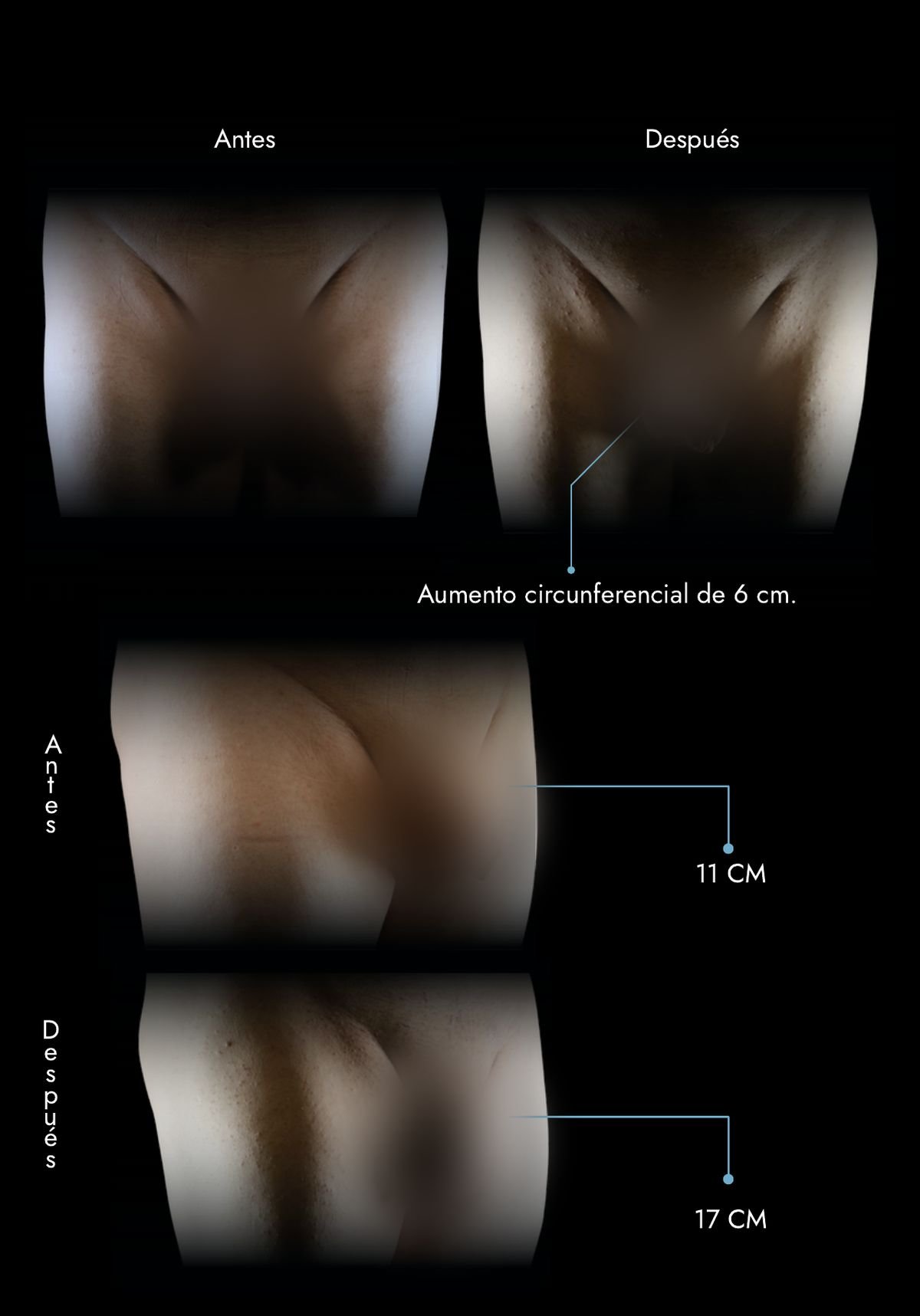 Penile girth enhancement with autologous fat grafting: 6 cm gain in circumference (11 cm to 17 cm), before and after, real case by Dr. Daniel Ramos, plastic surgeon in Bogotá, Colombia