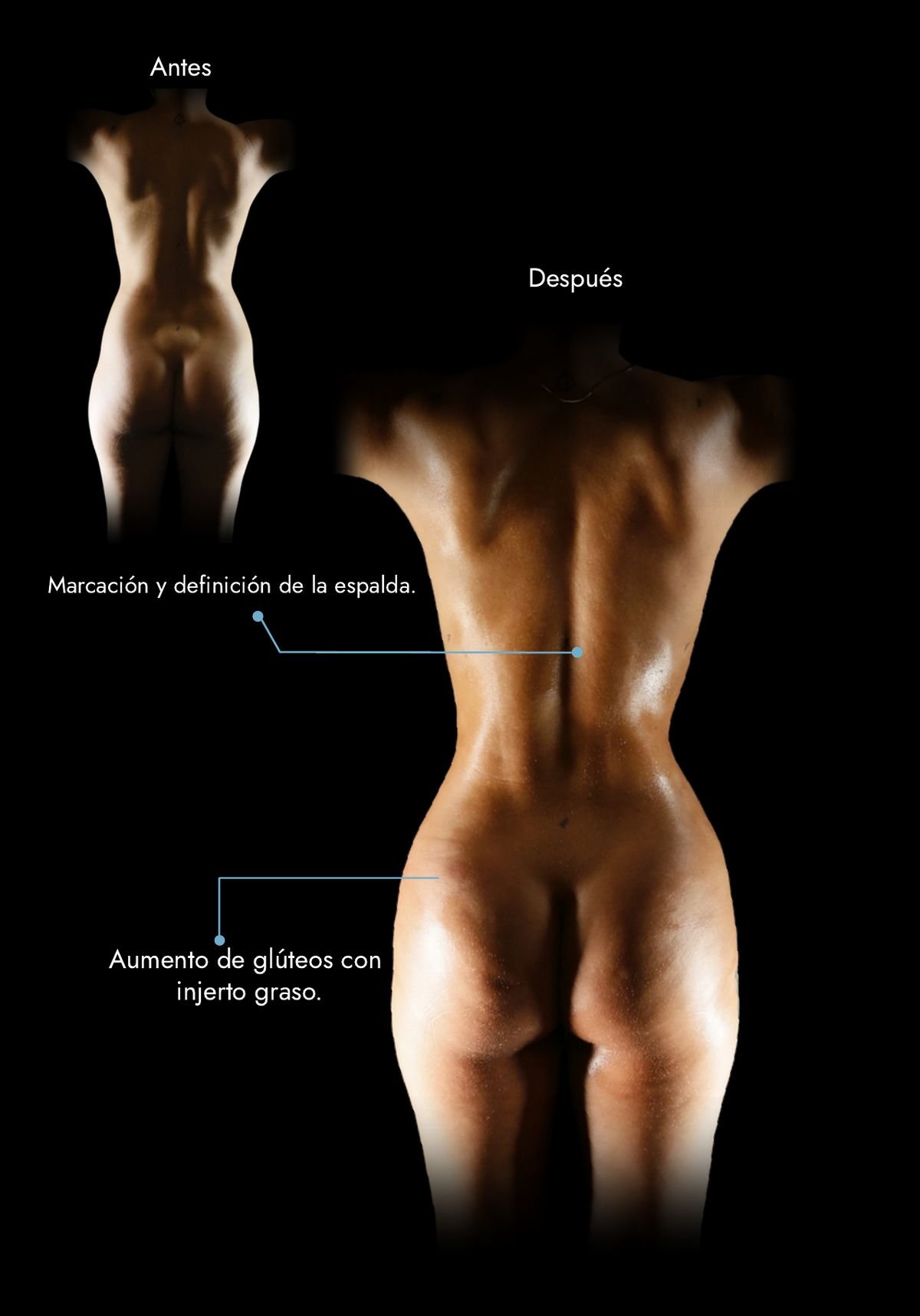Brazilian butt lift with the patient’s own fat and back marking: before and after, real case by Dr. Daniel Ramos, plastic surgeon in Bogotá, Colombia