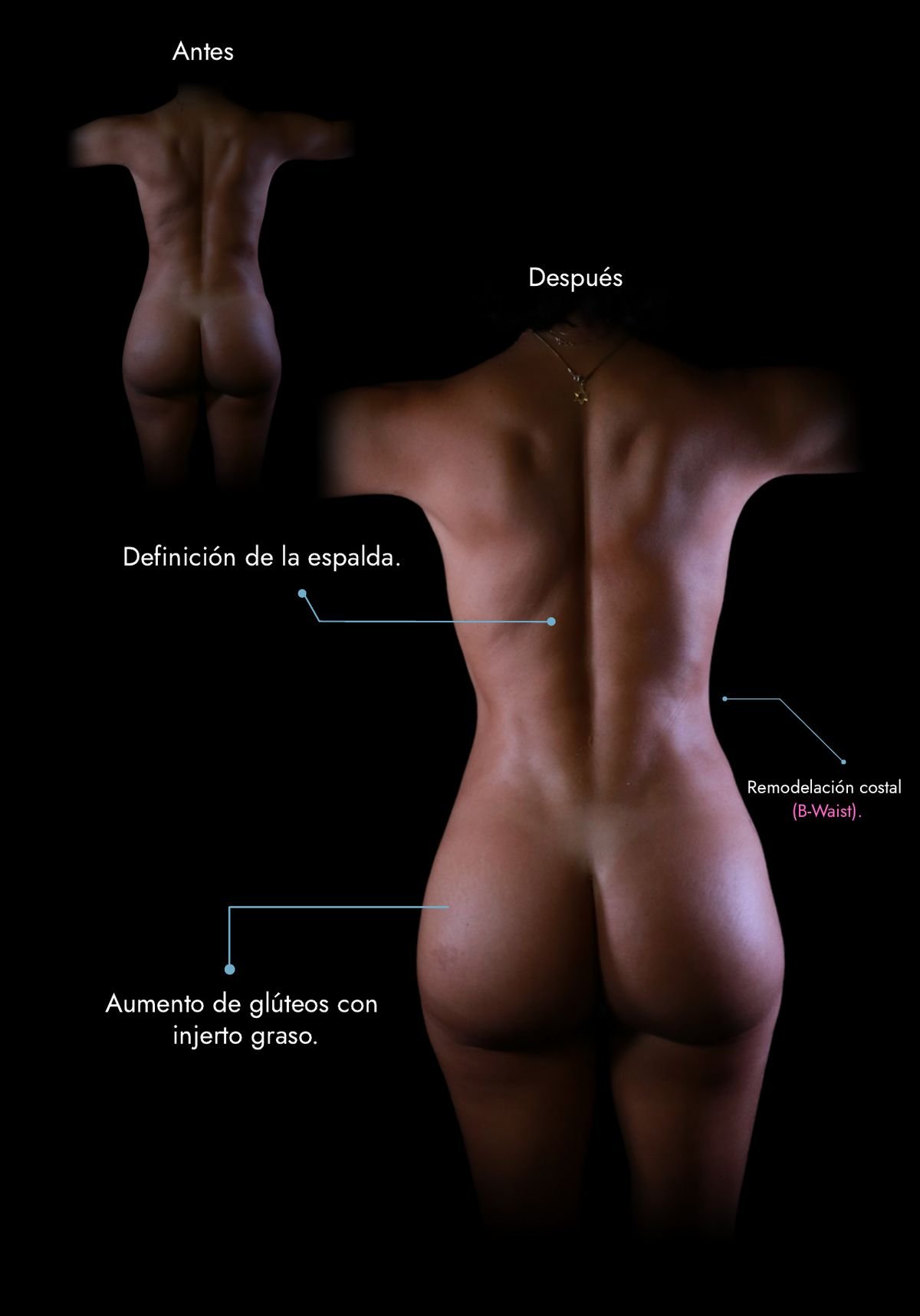BBL with Lipo HD and rib remodelling (B-Waist): before and after, real case by Dr. Daniel Ramos, plastic surgeon in Bogotá, Colombia