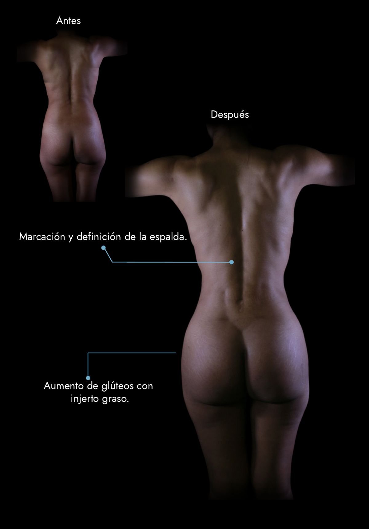 Buttock augmentation with fat grafting (BBL) and back definition: before and after, real case by Dr. Daniel Ramos, plastic surgeon in Bogotá, Colombia