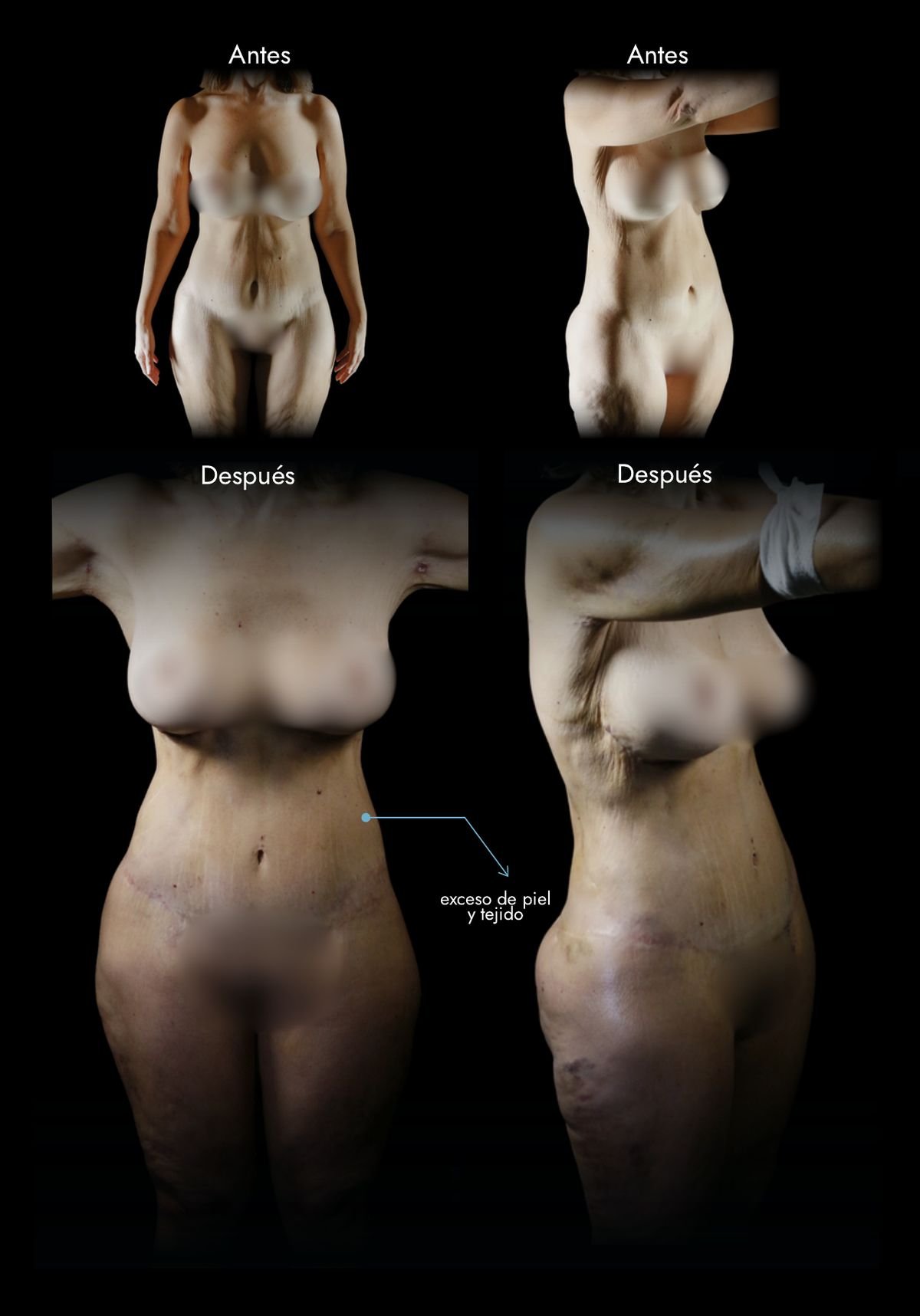 Tummy tuck in Colombia: abdomen before and after lipectomy with plication, a real case by Dr. Daniel Ramos