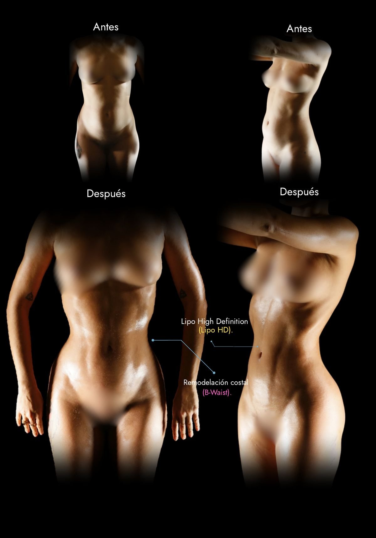 Rib remodeling in Colombia: waist before and after Lipo HD with rib remodeling (B-Waist), real case by Dr. Daniel Ramos