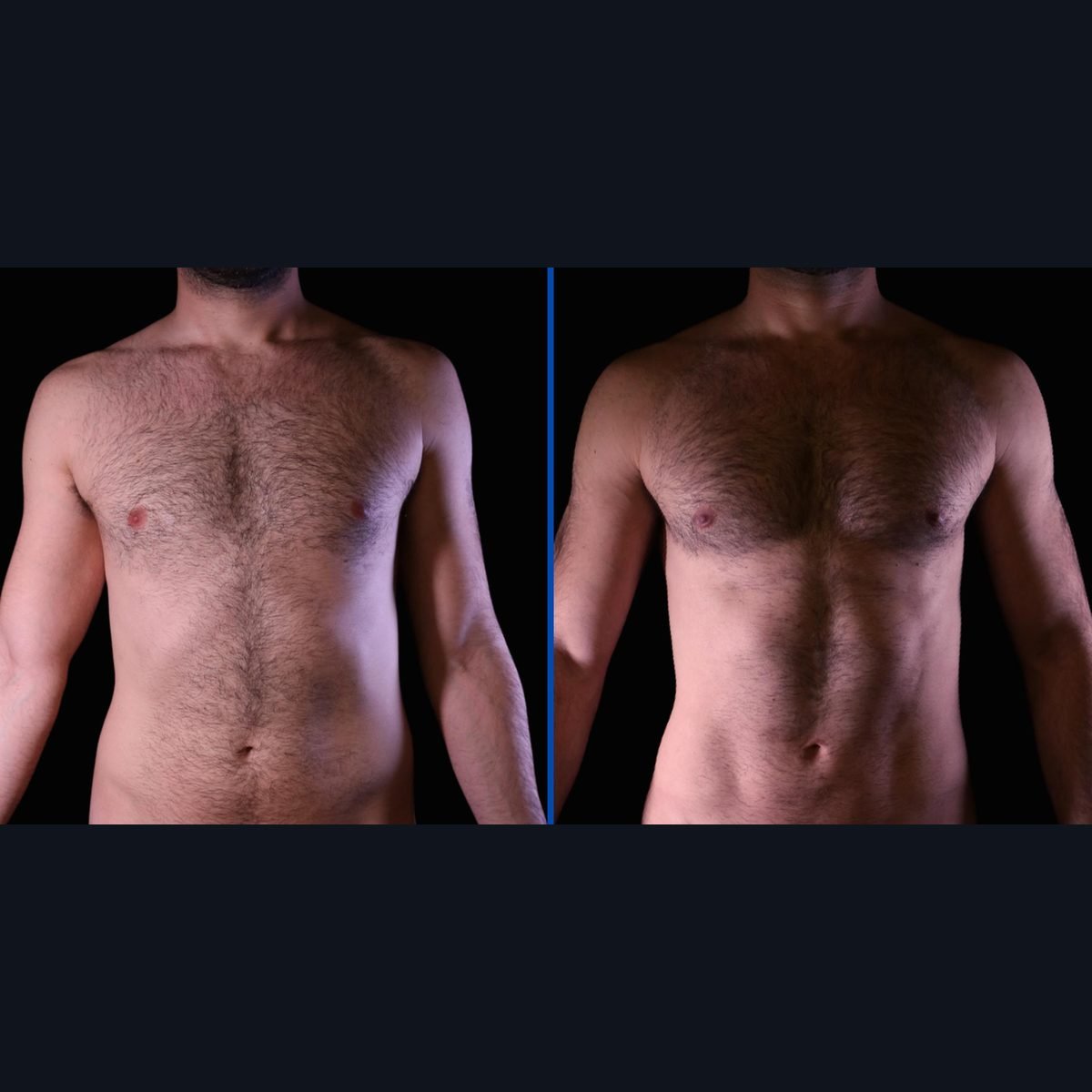 Male Lipo 360 in Colombia: abdomen before and after high-definition liposuction with Dr. Daniel Ramos