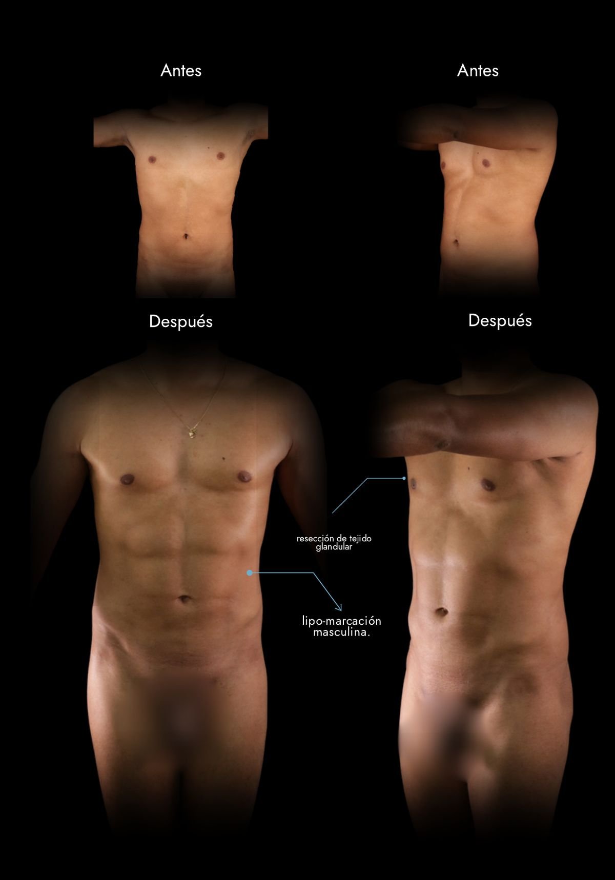 High-definition abdominal etching in men: before and after, real case by Dr. Daniel Ramos, plastic surgeon in Bogotá, Colombia