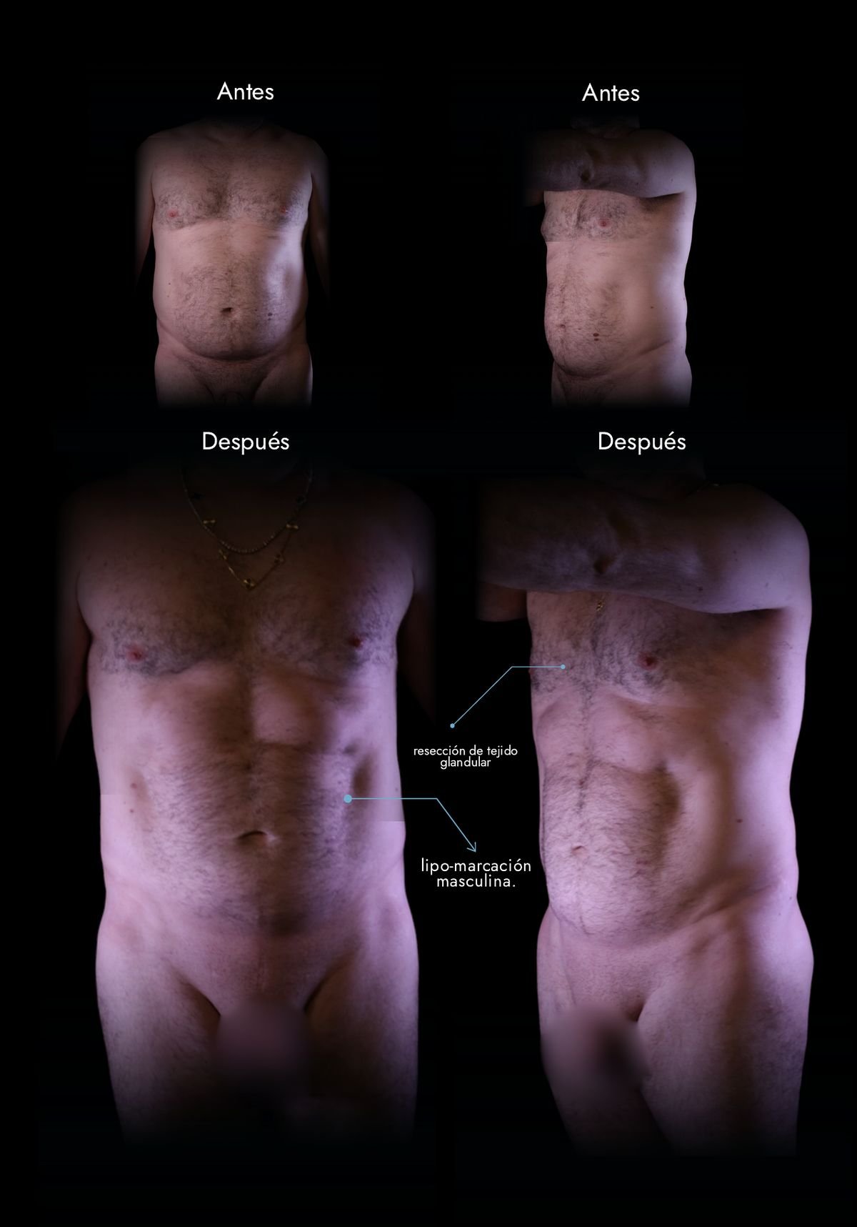 Male Lipo HD: abdomen, chest and waist before and after, real case by Dr. Daniel Ramos, plastic surgeon in Bogotá, Colombia