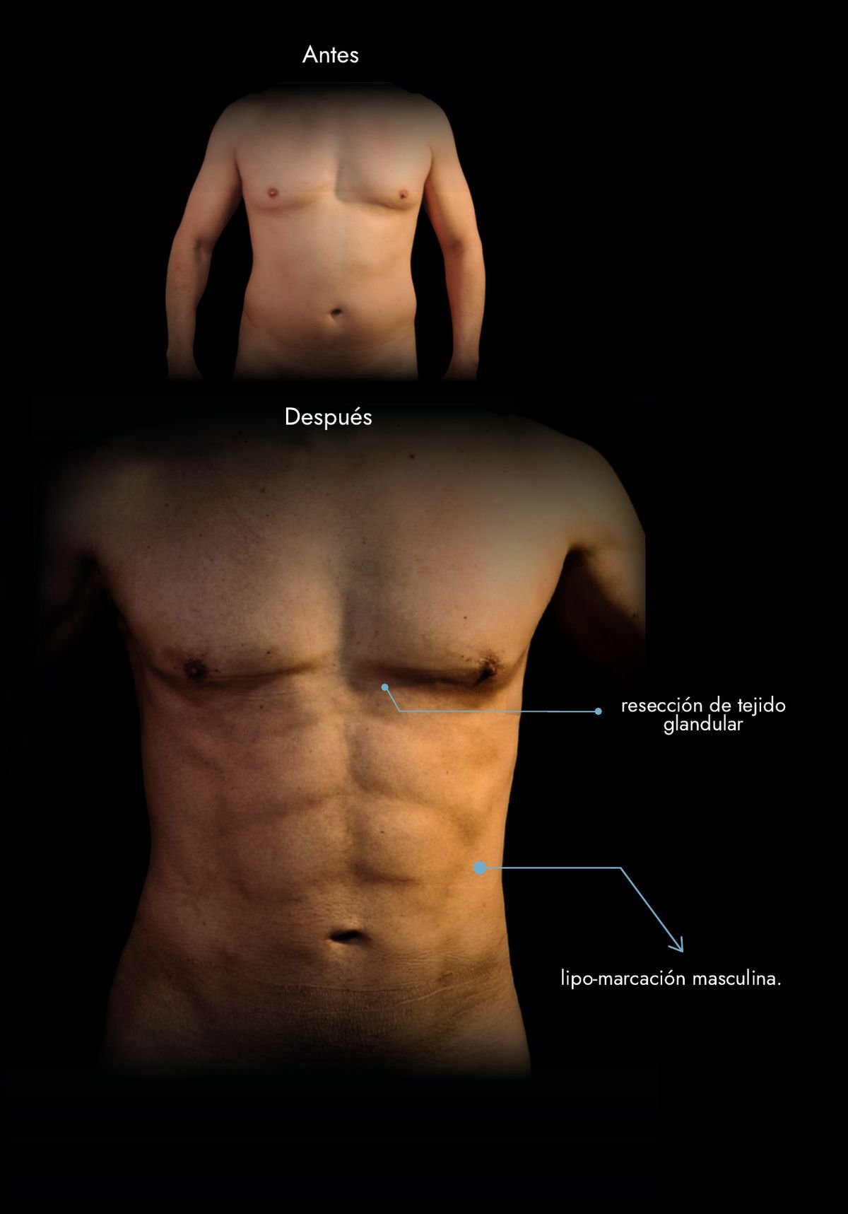 Male HD liposuction with gland resection (gynecomastia): before and after, real case by Dr. Daniel Ramos, plastic surgeon in Bogotá, Colombia